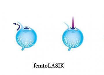 جراحة تصحيح أخطاء العين المسماة بـ "فمتو ليزك" أي femto LASIK