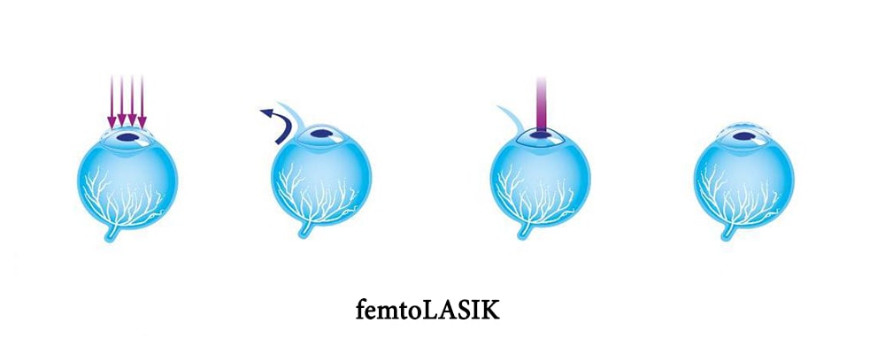 جراحة تصحيح أخطاء العين المسماة بـ "فمتو ليزك" أي femto LASIK