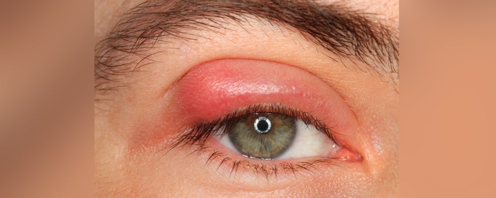 ما هو الكالزيون في العين و ما هي أعراضه وعلاجه؟