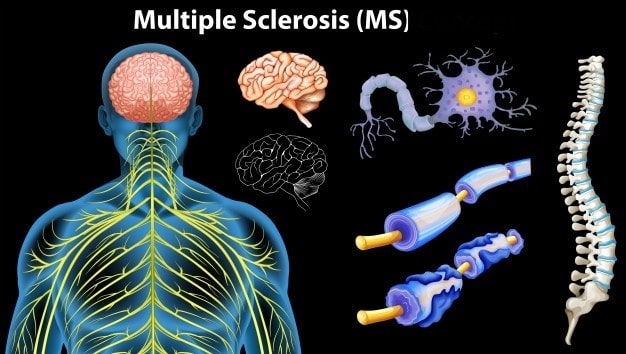 علاج لهجمات مرض التصلب العصبي المتعدد ( MS )