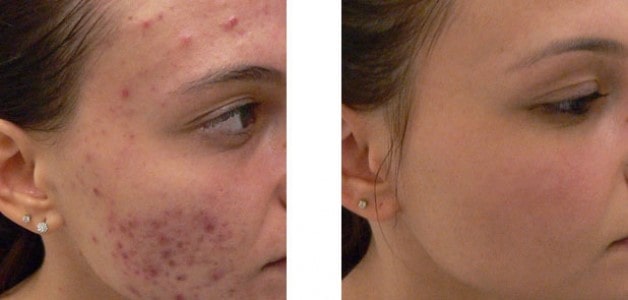  علاج مختلف أنواع حبوب الوجه
