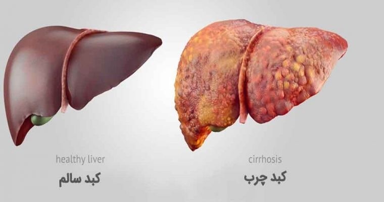 الكبد الدهني غير الكحولي