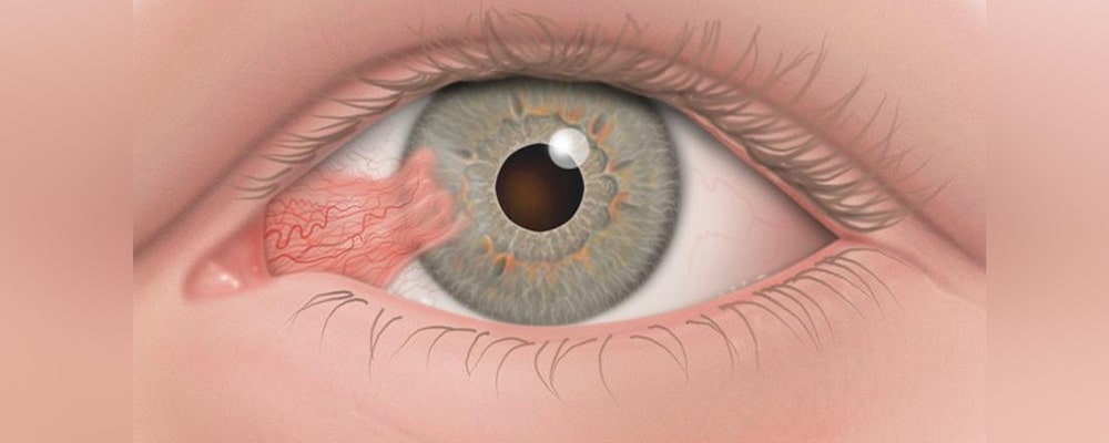 What is Pterygium?