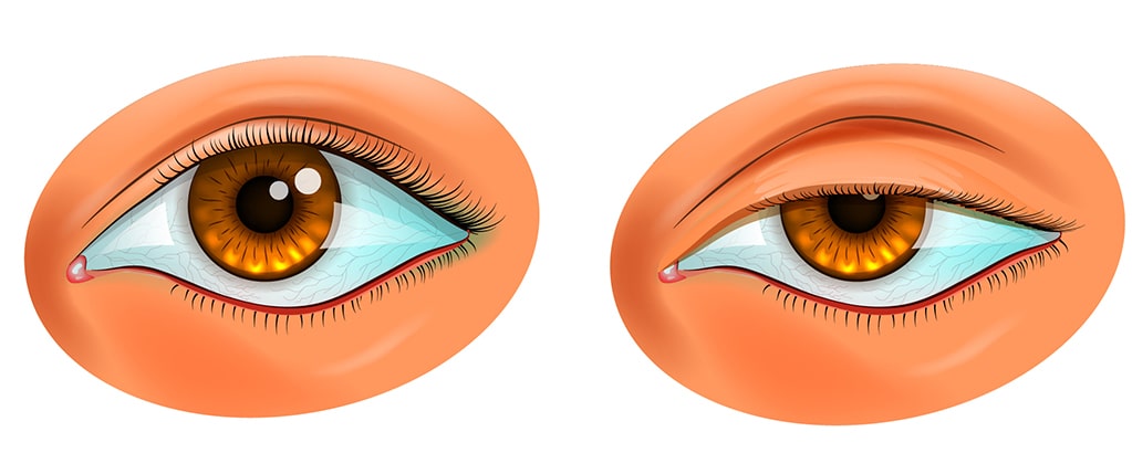 Ptosis surgery and complications