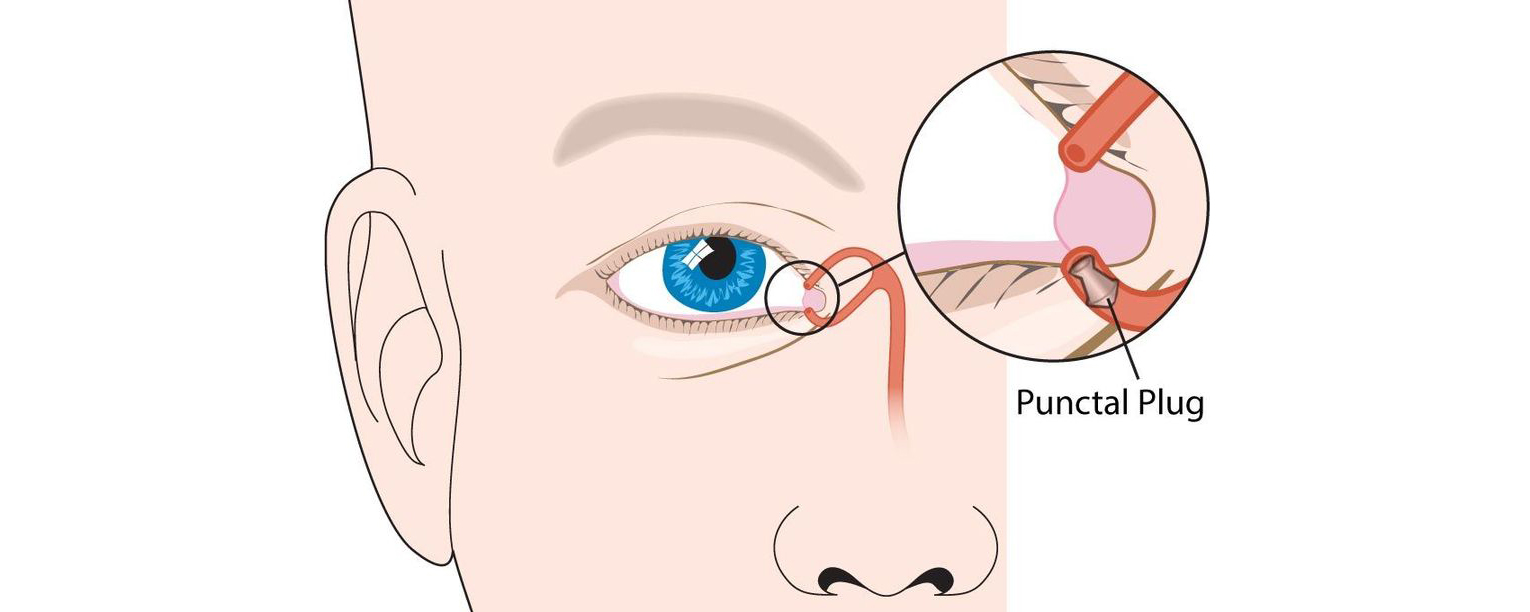 Punctal Plug as a treatment for dry eyes