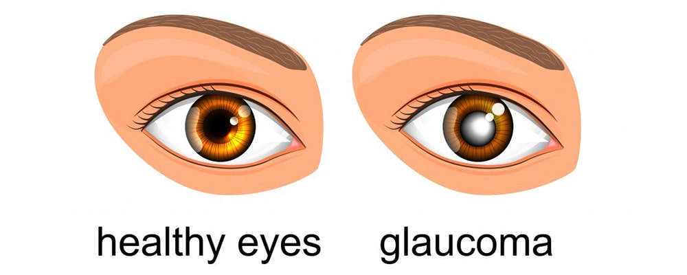 Glaucoma symptoms and treatment method