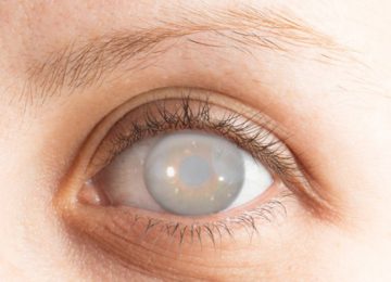 Cataracts, symptoms and treatment