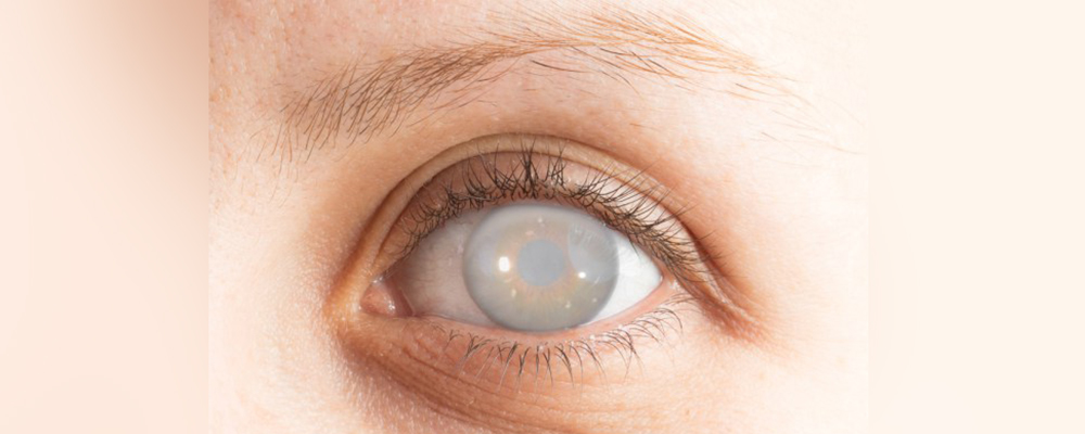 Cataracts, symptoms and treatment