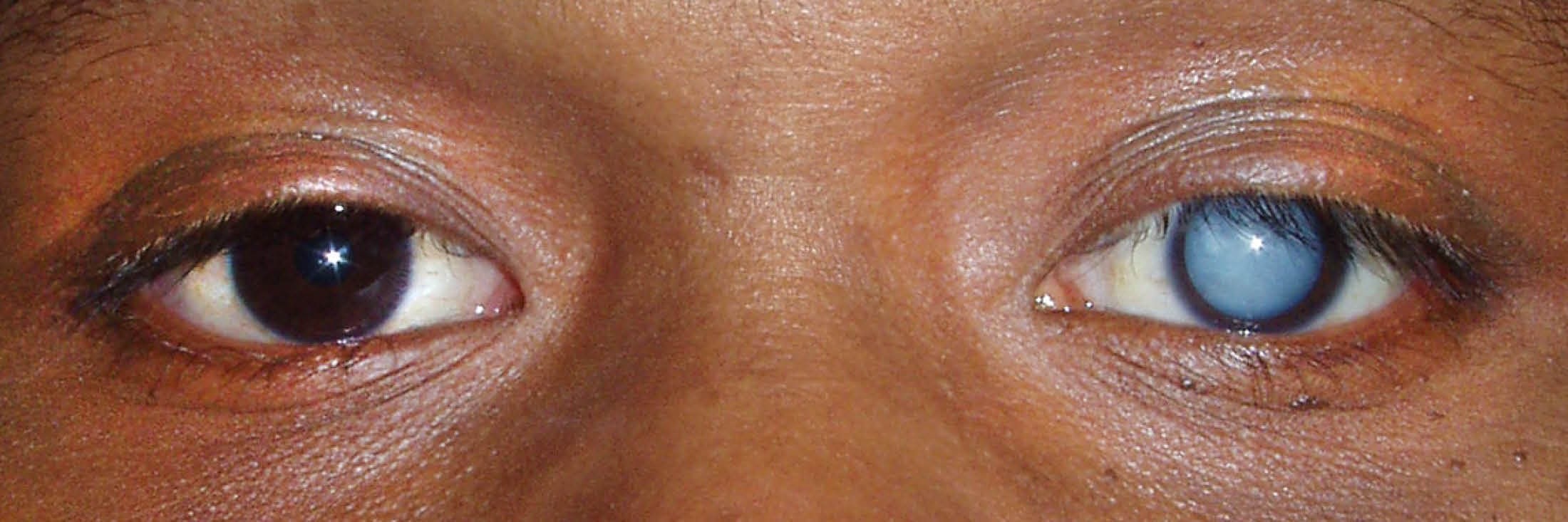 Cataracts