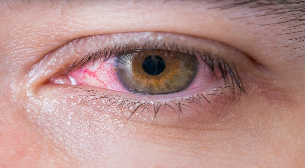 Conjunctivitis (pinkeye)