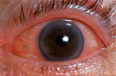 eye diseases