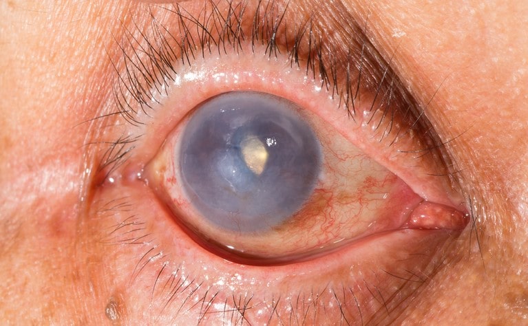 Uveitis