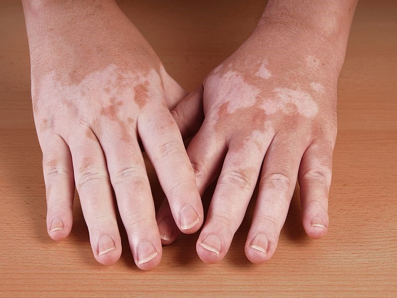 What are the vitiligo’s symptoms