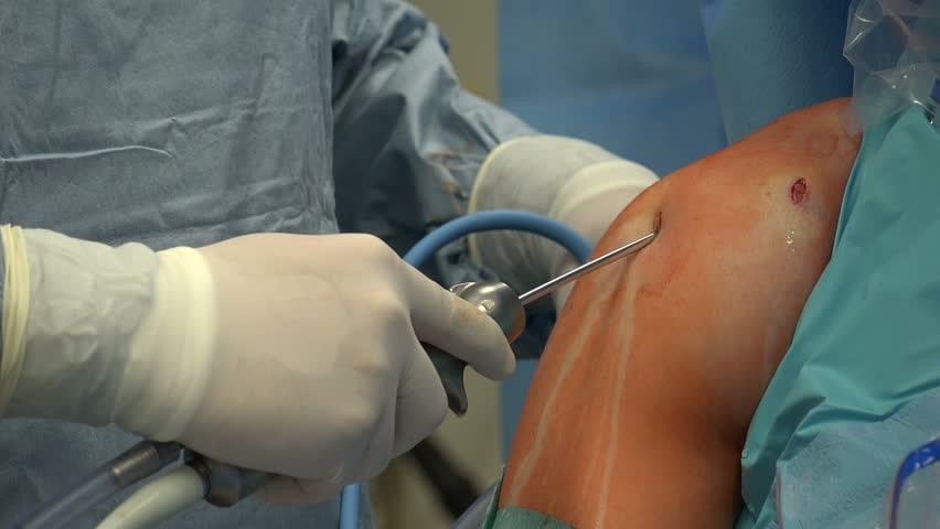 What do you know about shoulder surgery?