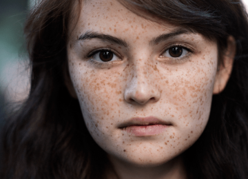 Are there solutions for preventing or treating the facial spots