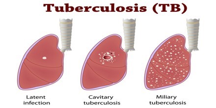 Tuberculosis has the highest mortality rate among infectious diseases!