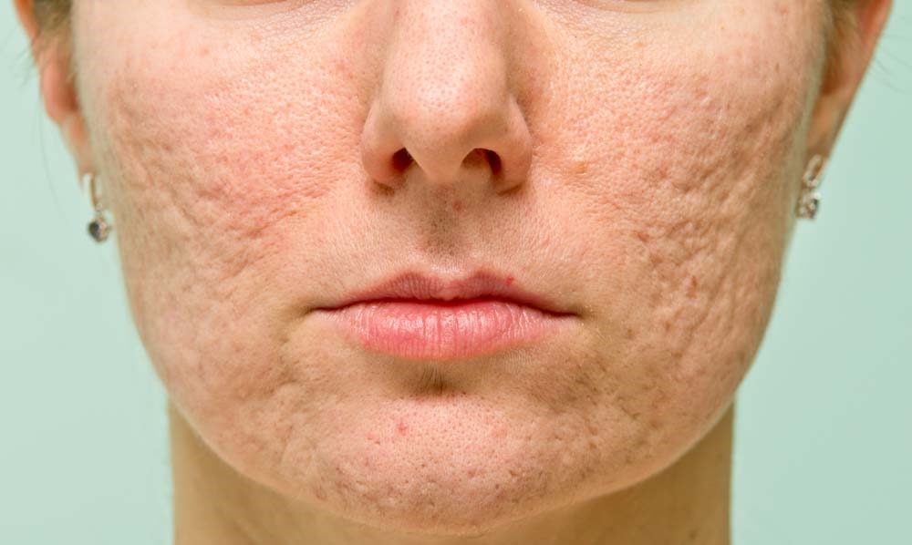 What solution do you choose to treat Acne scars