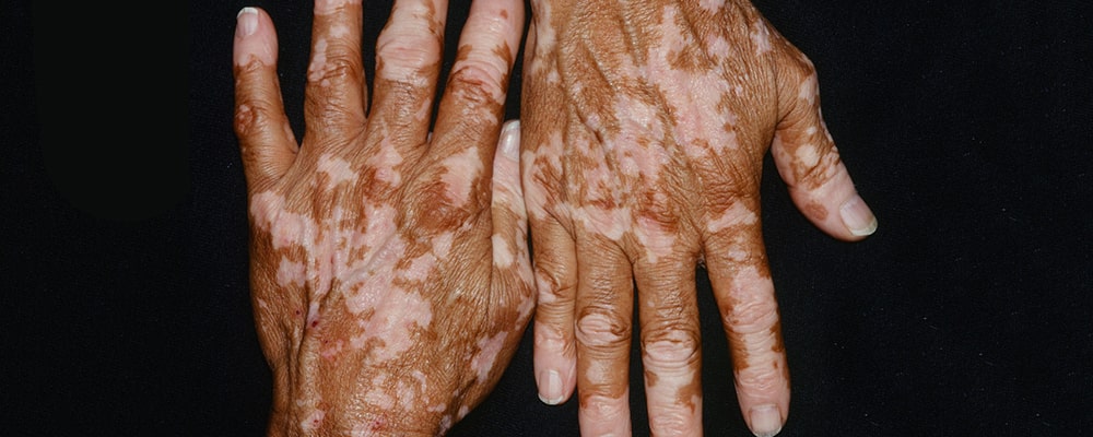 The Vitiligo disease and loss of Skin Color