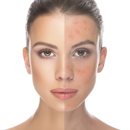 Different types of facial acne and their treatments