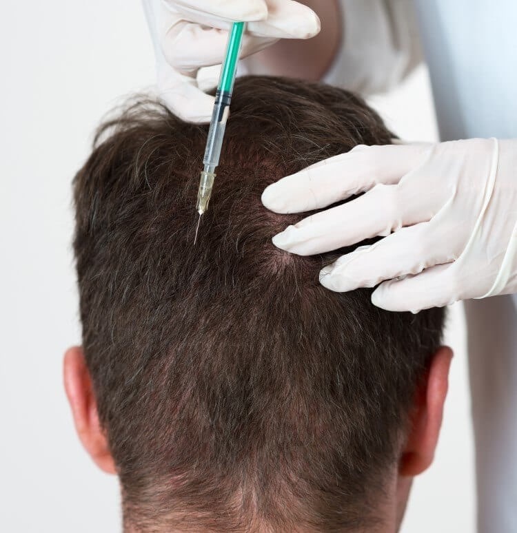 Mesotherapy and hair loss treatment