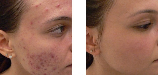 Treating different types of facial acne