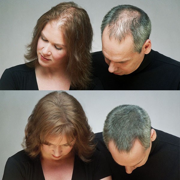 What are the main causes of hair loss and how can it be treated