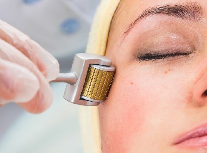 What do you know about Microneedling method