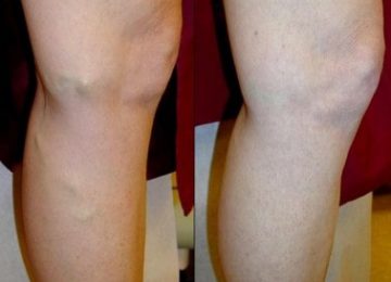 What is Varicose Veins