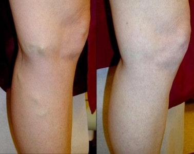 What is Varicose Veins
