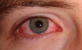 Eye irradiation effects