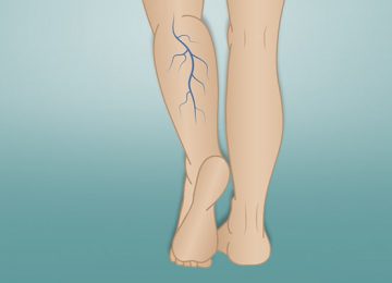 Varicose Veins , its causes and treatment