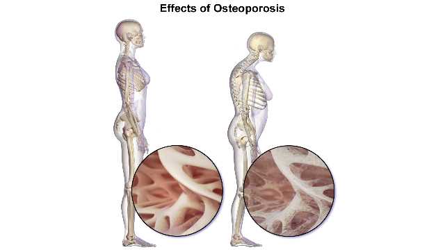 Symptoms of osteoporosis