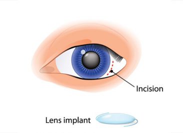 جراحی کاشت لنز ثانویه (Secondary lens implantation)