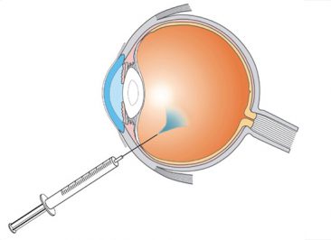 جراحی تزریق چشمی (اینتراویترال)