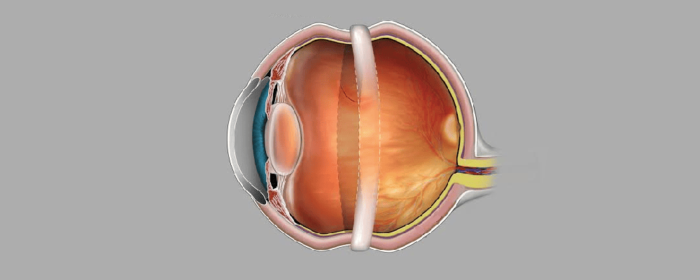 جراحی اسکلرال باکلینگ چشم (Scleral buckling)