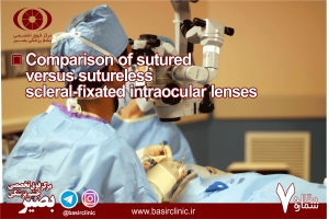 بررسی دو تکنیک sutured و sutureless در قراردهی لنزهای داخل چشمی