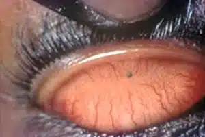 علائم بیماری : احساس جسم خارجی ، اشک ریزش و سابقه ضربه به چشم