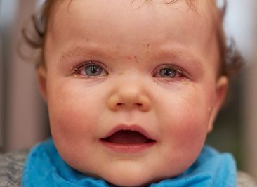  شایع‌‌ترین و خطرناک‌ترین نوع عفونت چشم کودکان چیست؟