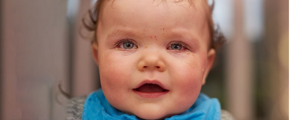  شایع‌‌ترین و خطرناک‌ترین نوع عفونت چشم کودکان چیست؟