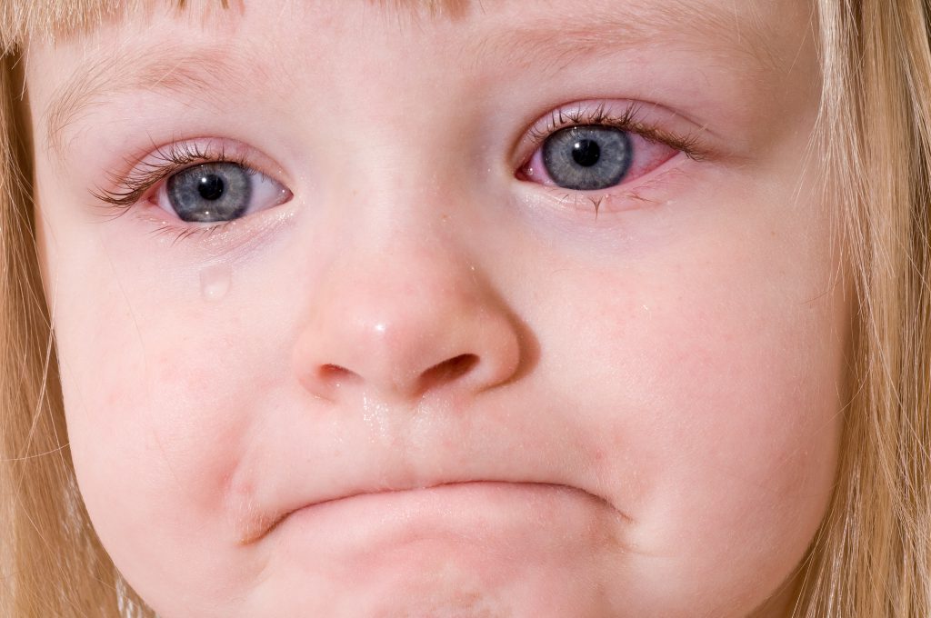 عفونت چشم کودکان – سلولیت