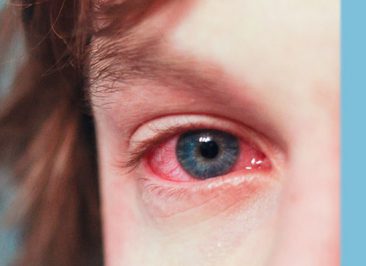 درمان قرمزی چشم و علل ایجاد آن چیست؟