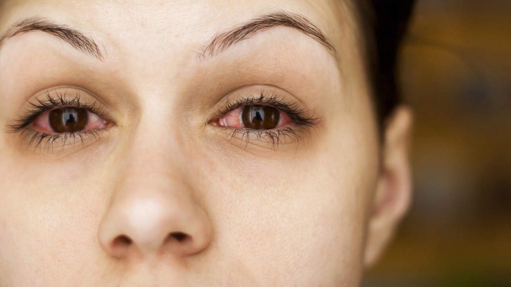 حساسیت و آلرژی های چشم